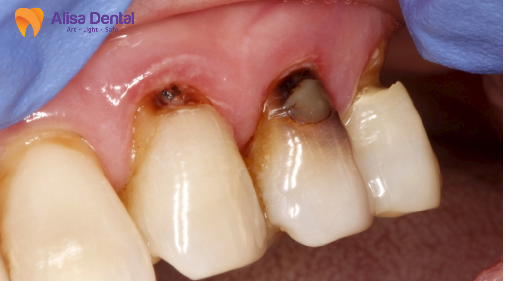 phuong-phap-tay-trang-rang-hien-nay