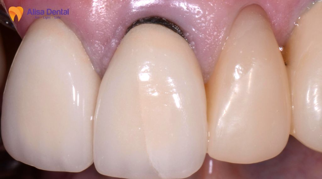 Răng sứ bị đen viền nướu