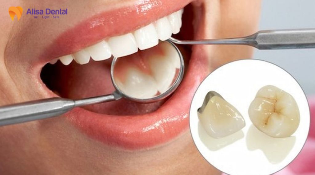 Răng sứ bị đen viền nướu