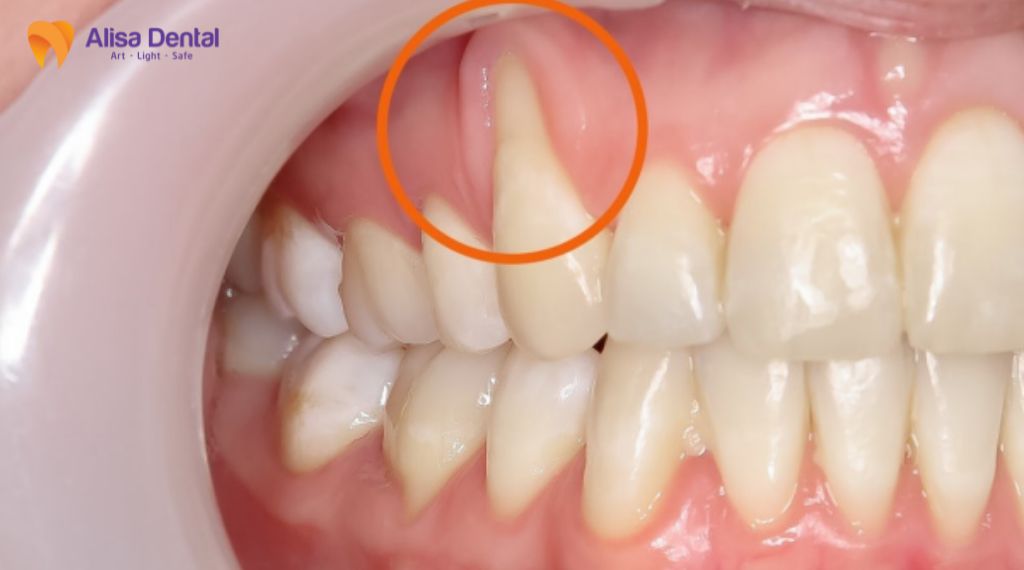 Răng sứ bị đen viền nướu