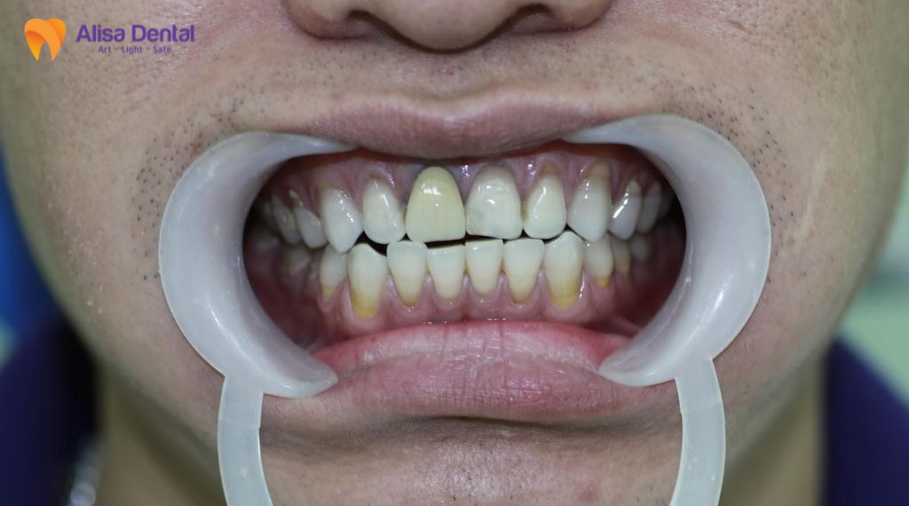 Răng sứ bị đen viền nướu