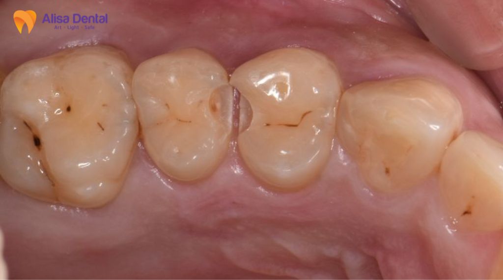 Sâu răng có tự khỏi không