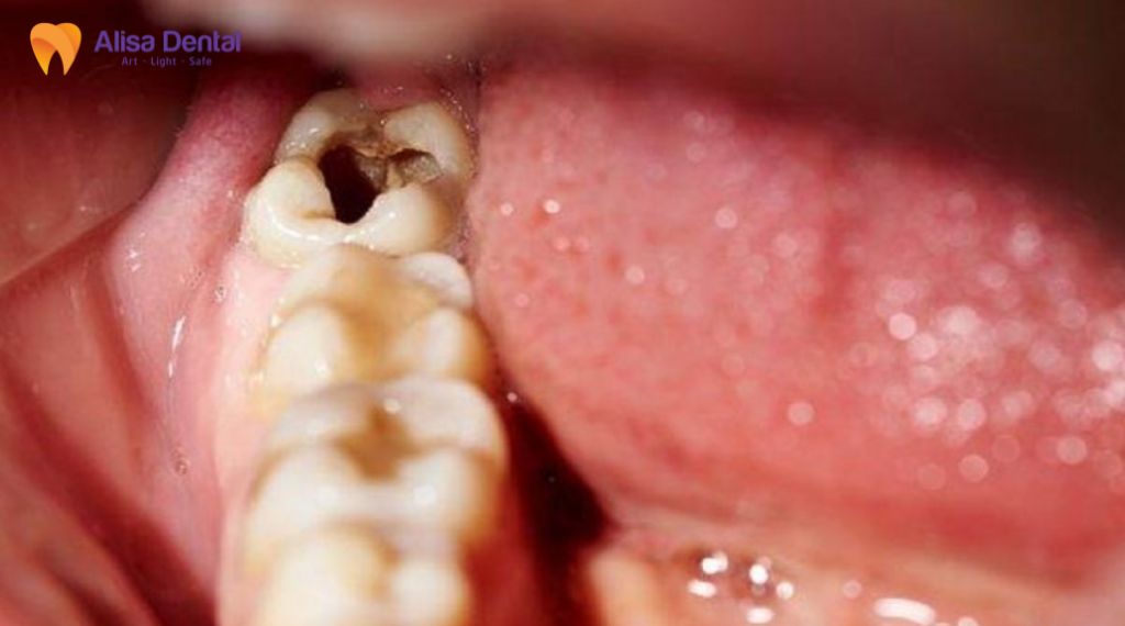 Sâu răng có tự khỏi không