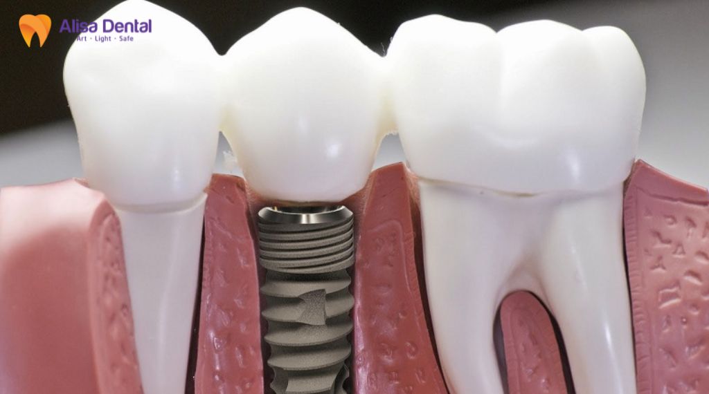 So sánh implant và cầu răng sứ
