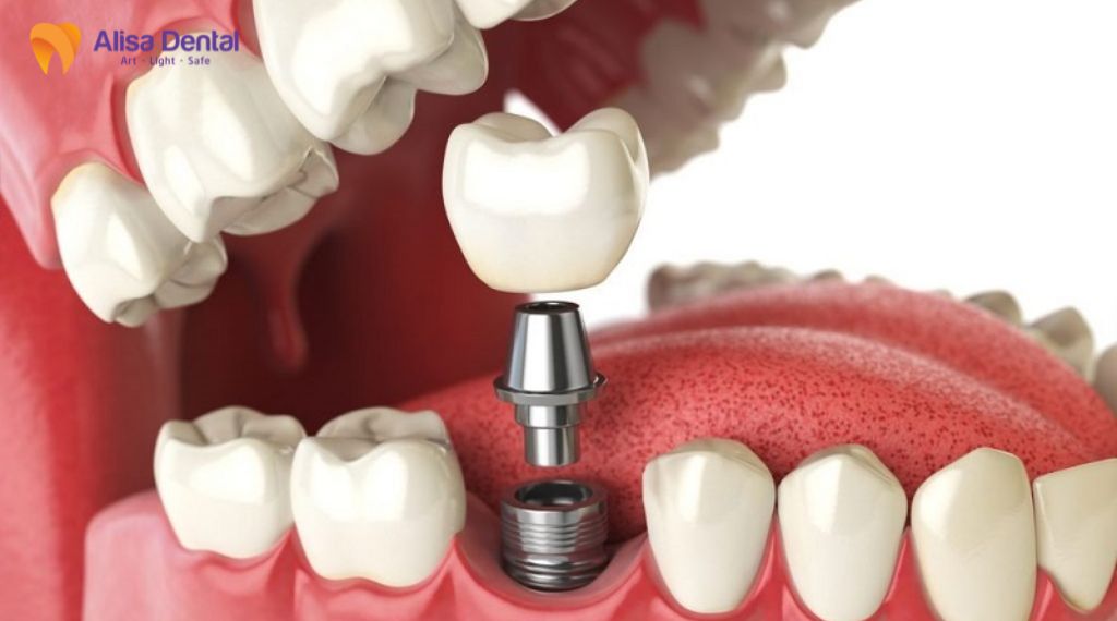 So sánh implant và cầu răng sứ