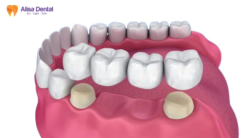 So sánh implant và cầu răng sứ
