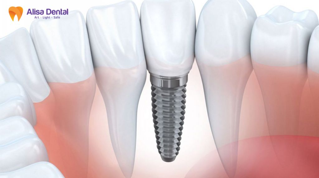 So sánh implant và cầu răng sứ