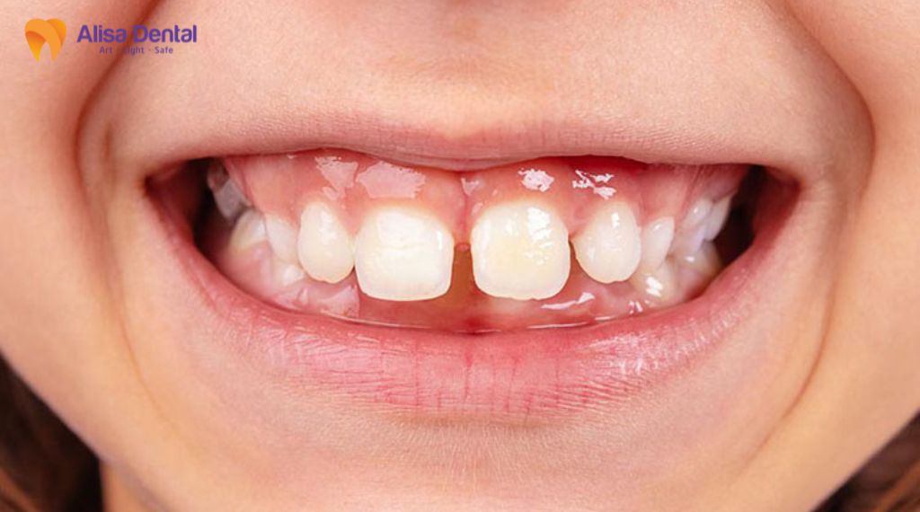 Trẻ em mấy tuổi thay răng