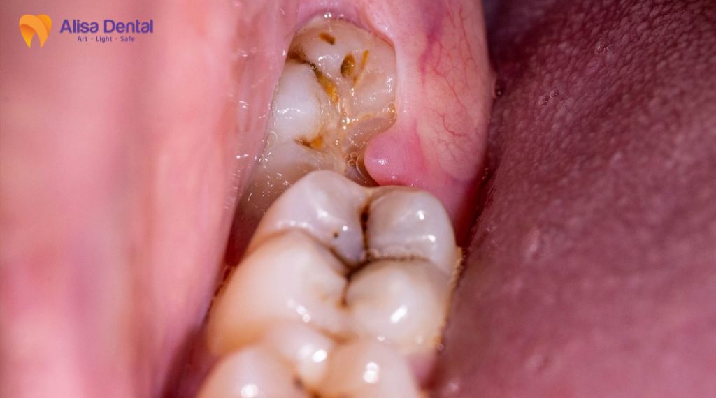 Viêm lợi trùm răng khôn