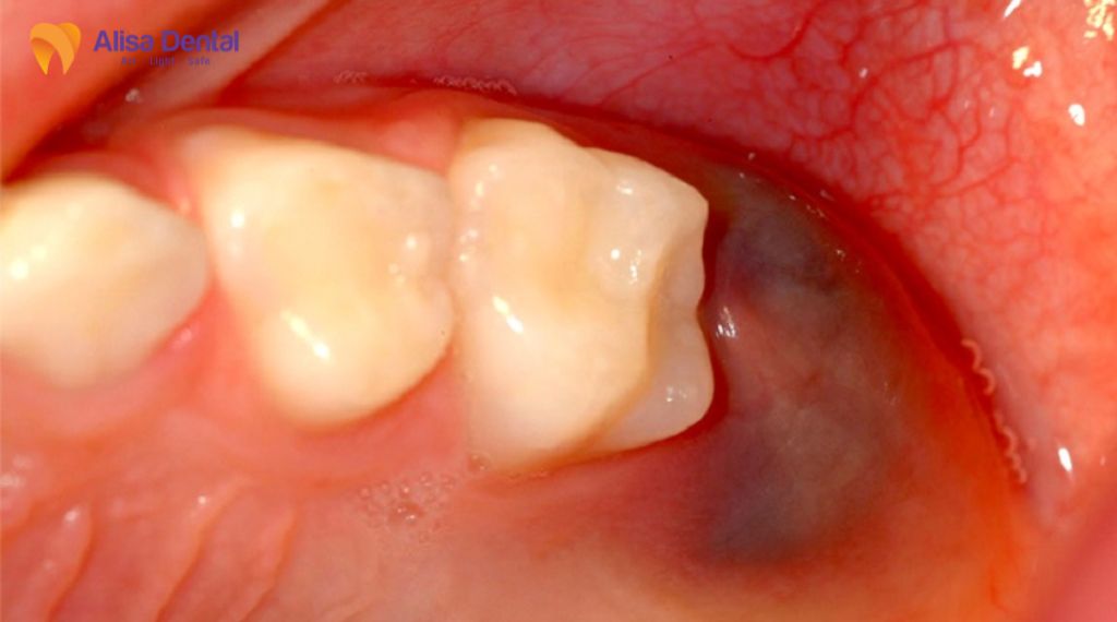 Viêm lợi trùm răng khôn