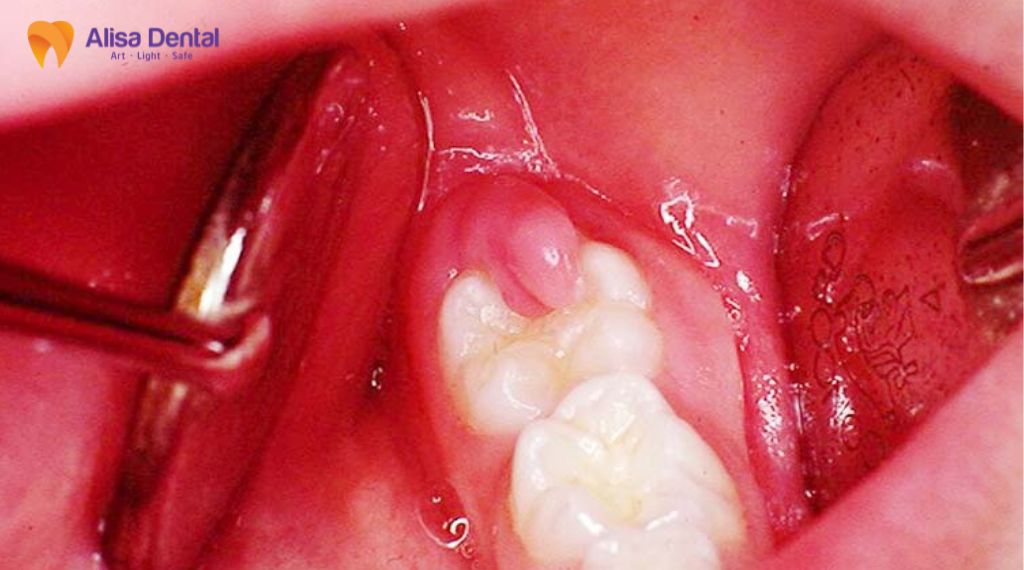 Viêm lợi trùm răng khôn