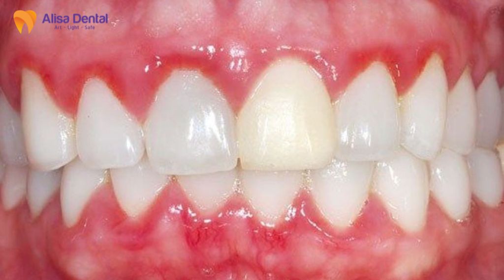 Viêm nha chu là gì