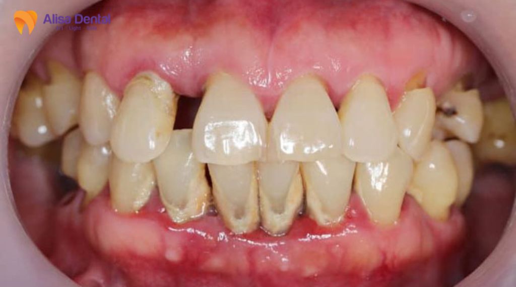 Viêm nha chu là gì