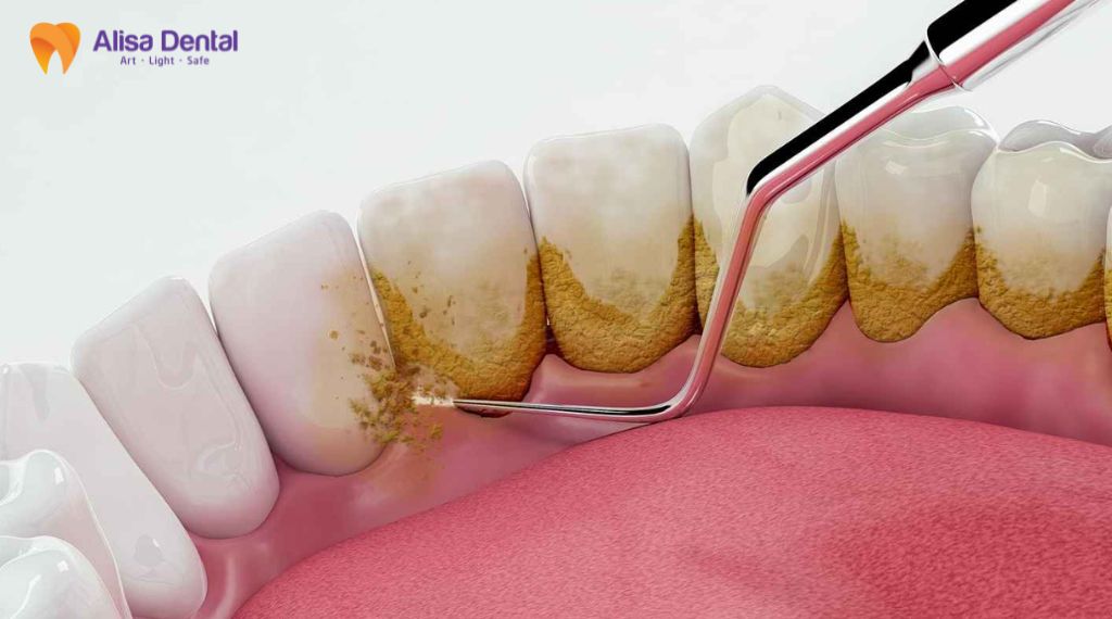 Viêm nha chu là gì