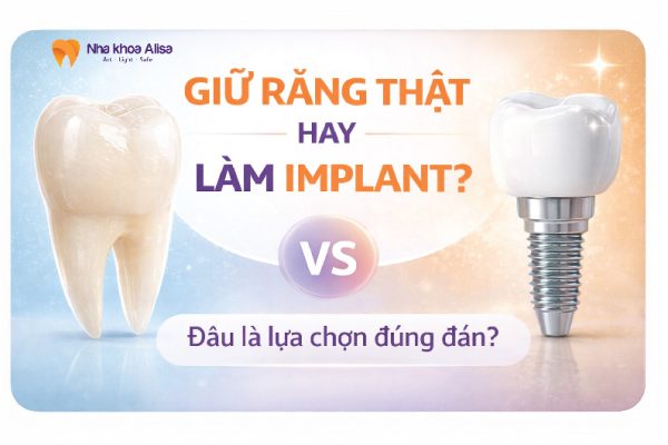 Giữ Răng Thật Hay Làm Implant