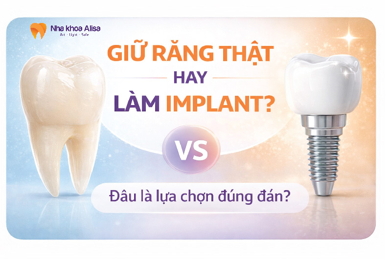Giữ Răng Thật Hay Làm Implant