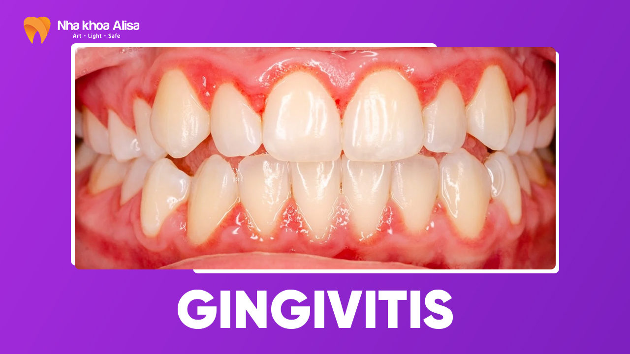 Gingivitis – All You Need to Know