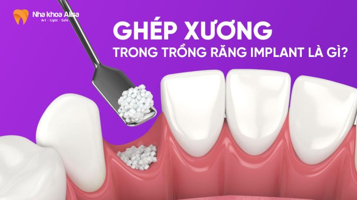 Ghép xương trong trồng răng implant là gì