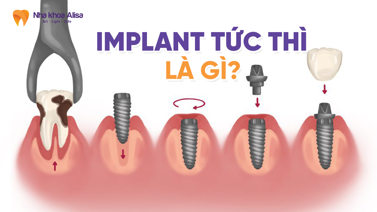 implant-tuc-thi-la-gi