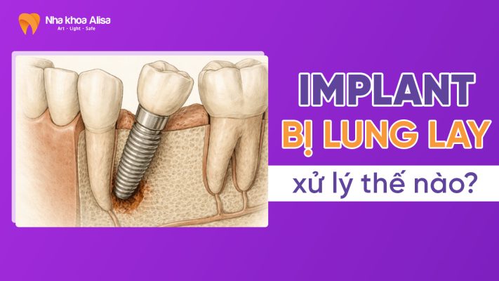 implant-bi-lung-lay-xu-ly-nhu-the-nao