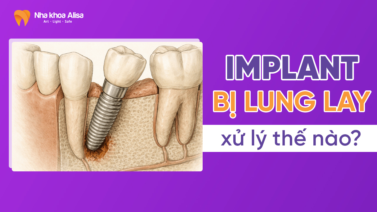 implant-bi-lung-lay-xu-ly-nhu-the-nao