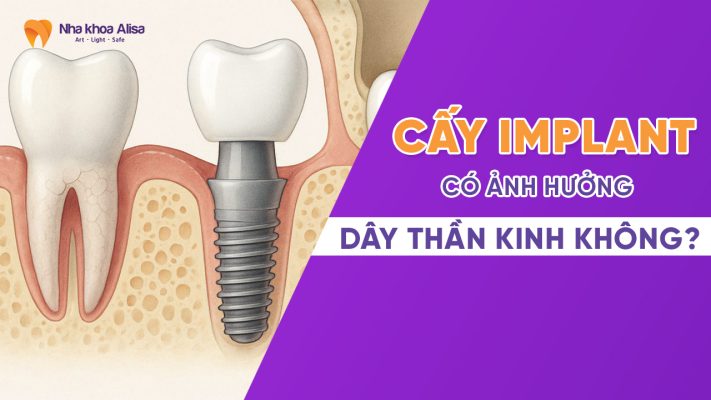 cay-implant-co-anh-huong-day-than-kinh-khong