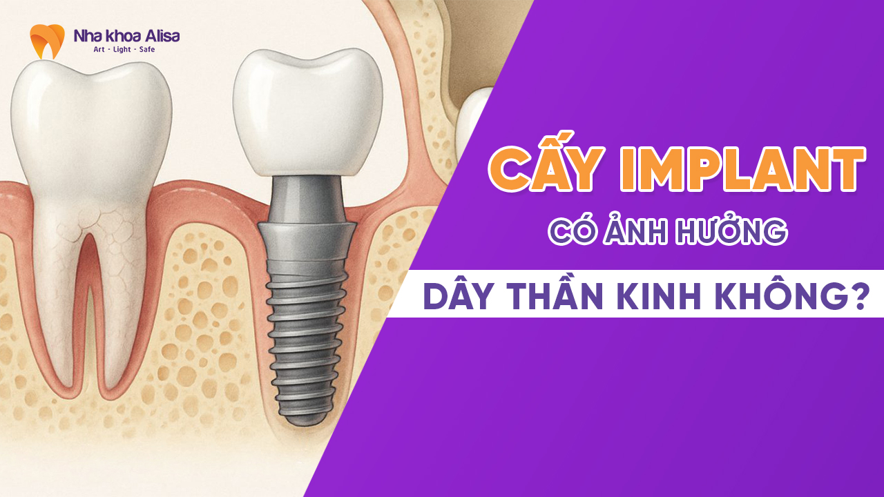cay-implant-co-anh-huong-day-than-kinh-khong