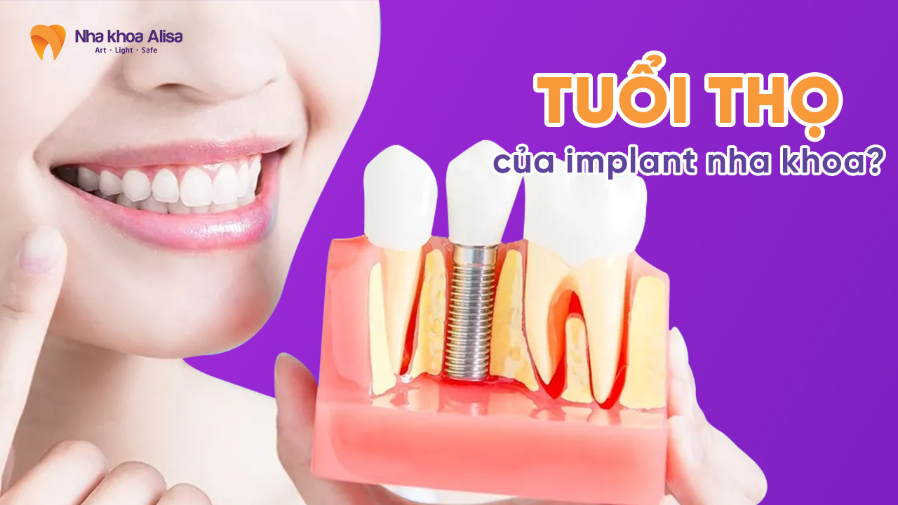 tuoi-tho-cua-implant-nha-khoa