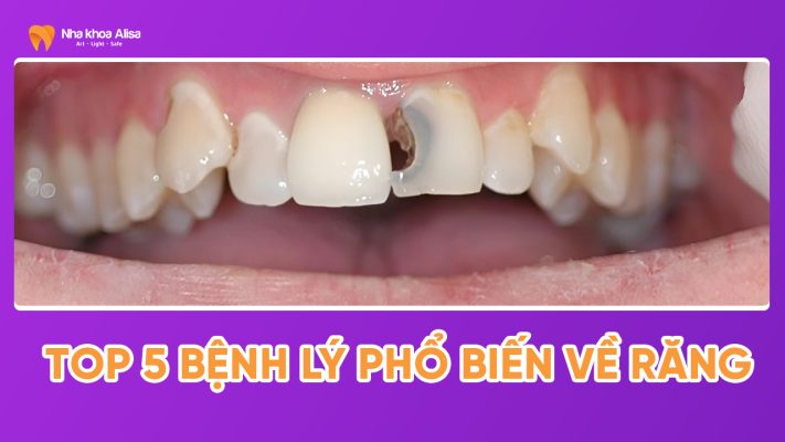 top-5-benh-ly-pho-bien-ve-rang