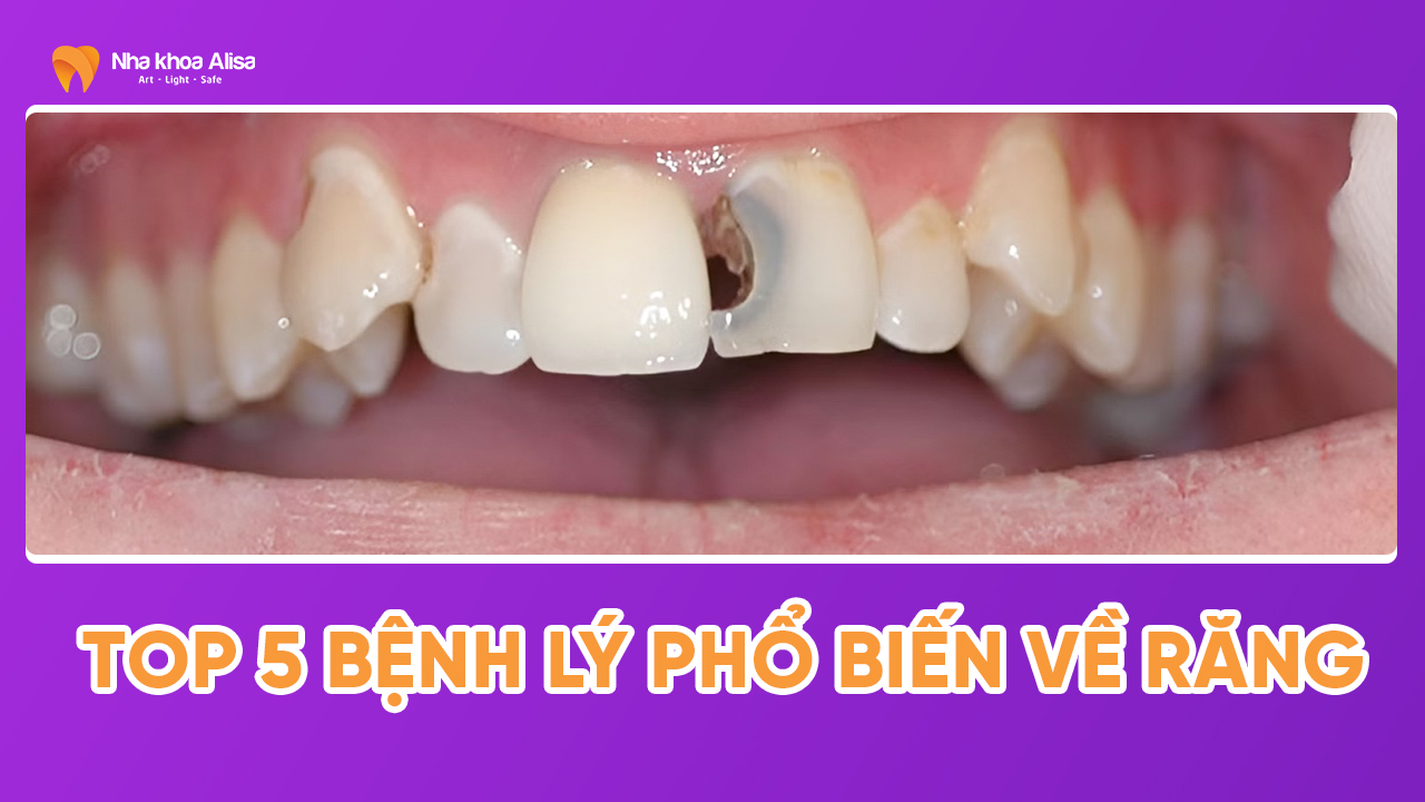 top-5-benh-ly-pho-bien-ve-rang