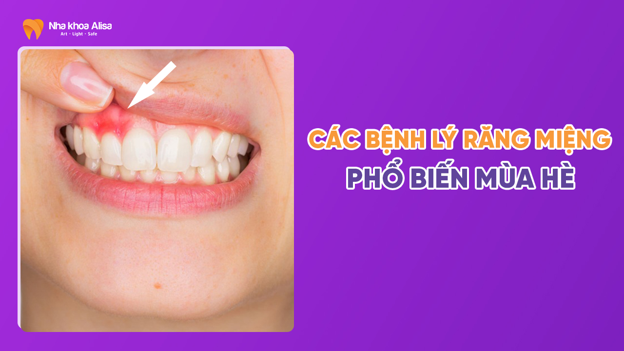 cac-benh-ly-rang-mieng-pho-bien-mua-he