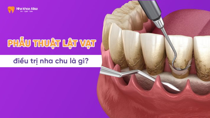 Phau-thuat-lat-vat-dieu-tri-nha-chu-la-gi