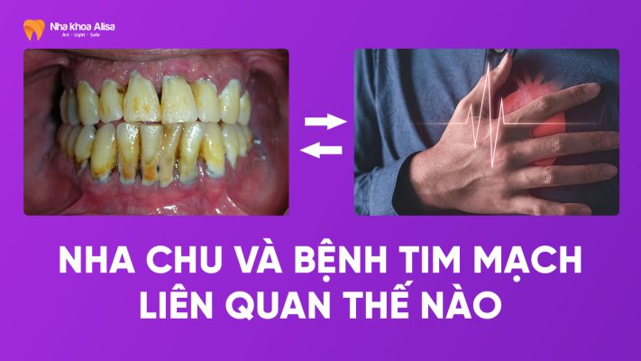 Nha chu và bệnh tim mạch liên quan thế nào