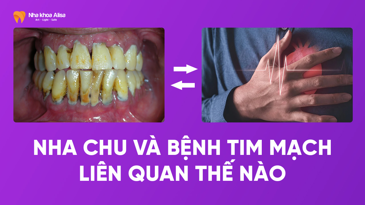 Nha chu và bệnh tim mạch liên quan thế nào