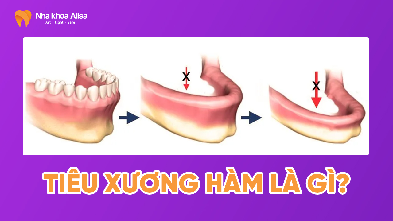 Tiêu xương hàm là gì