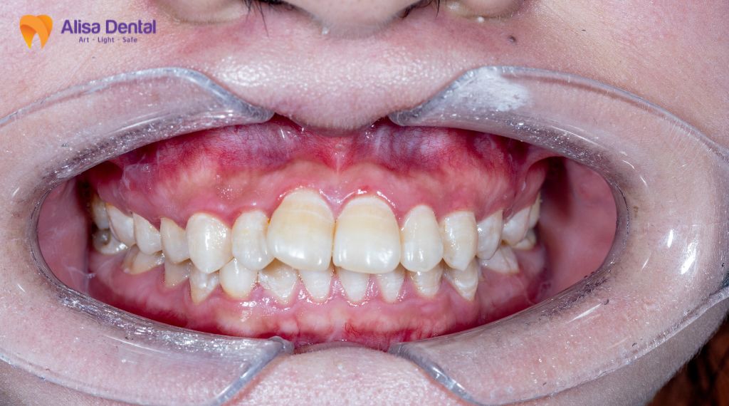 Gingivitis – All You Need to Know