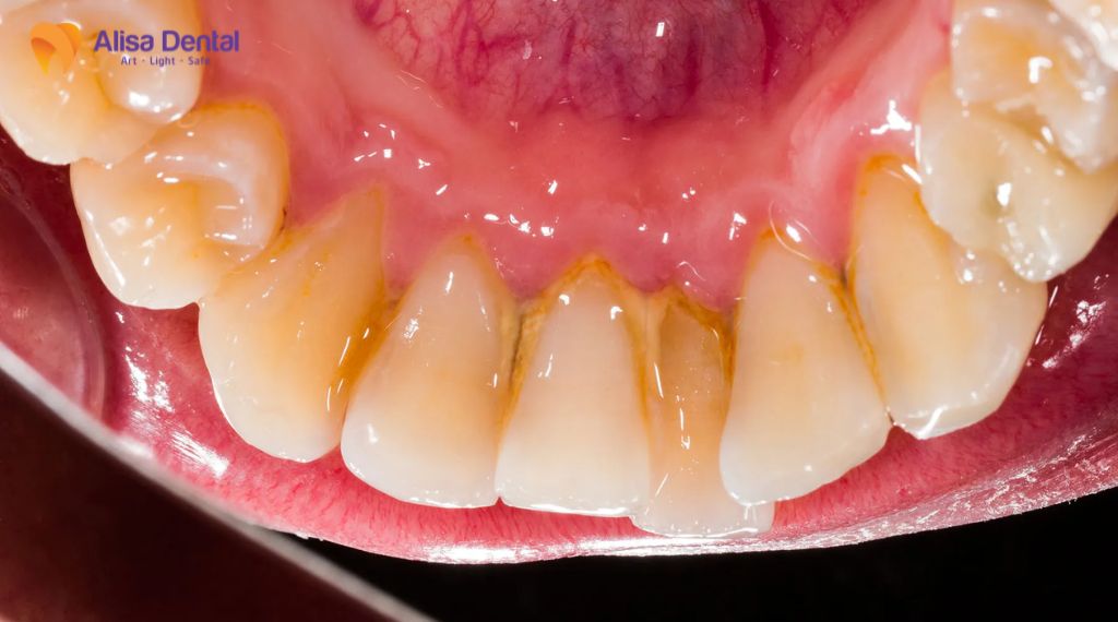 Gingivitis – All You Need to Know