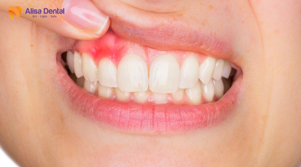Gingivitis – All You Need to Know