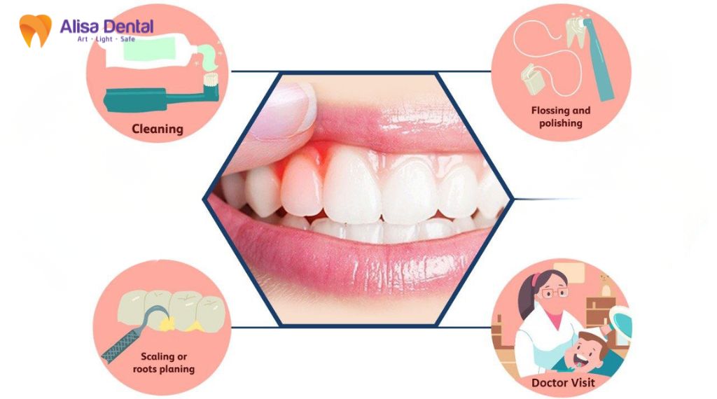 Gingivitis – All You Need to Know