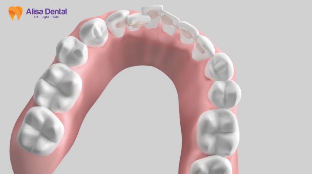 Alisa - Best Dental clinic for expat in Hanoi