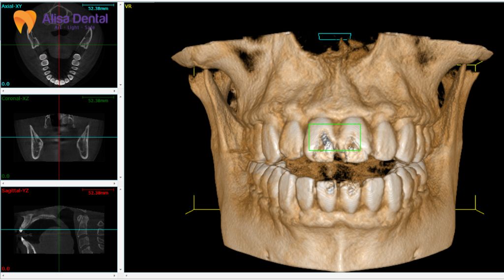 Alisa - Best Dental clinic for expat in Hanoi