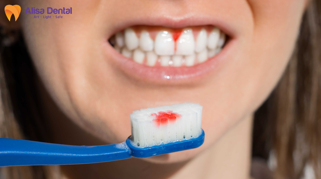 cac-benh-ly-rang-mieng-pho-bien-mua-he