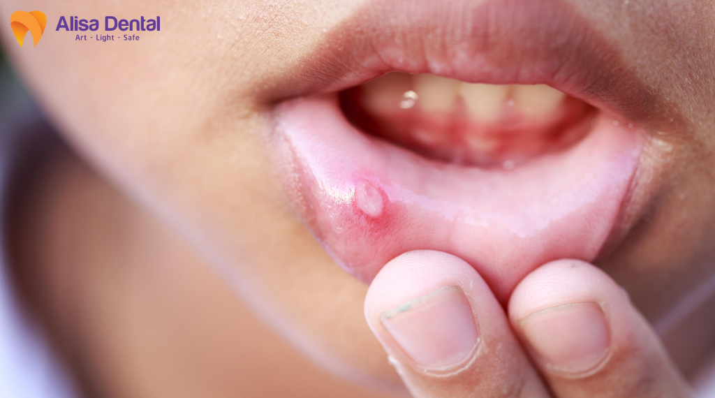 cac-benh-ly-rang-mieng-pho-bien-mua-he