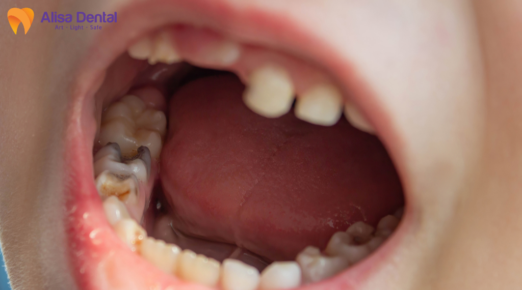 cac-benh-ly-rang-mieng-pho-bien-mua-he