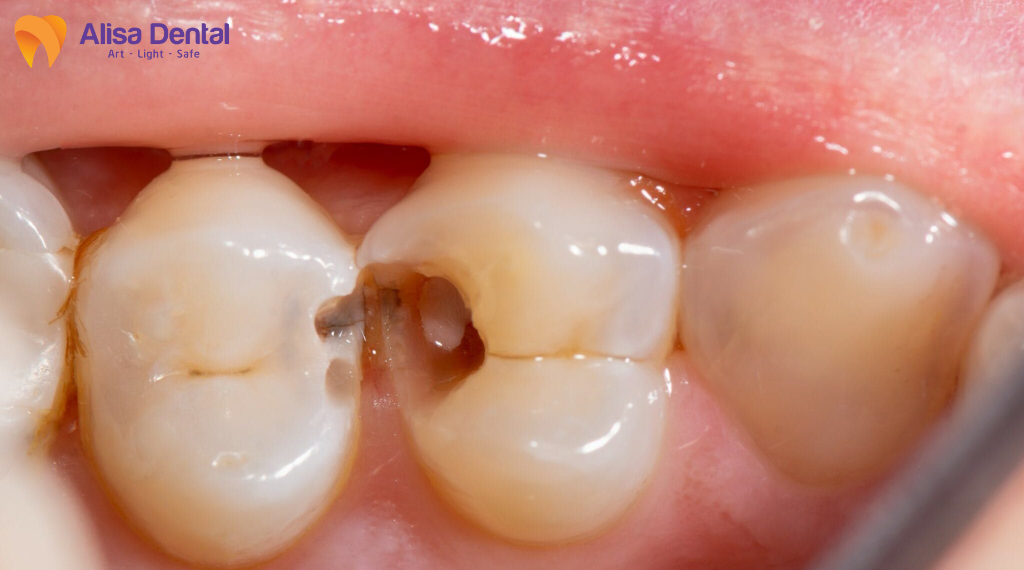 cac-benh-ly-rang-mieng-pho-bien-mua-he