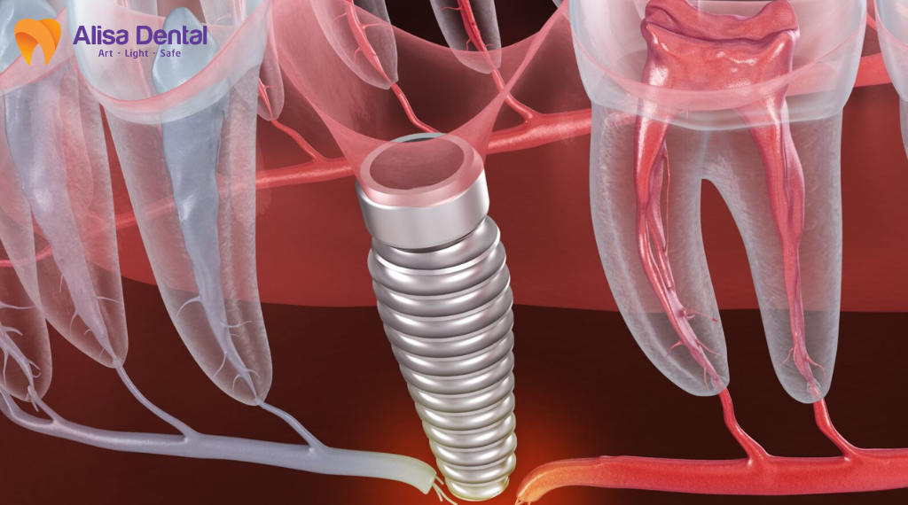 cay-implant-co-anh-huong-day-than-kinh-khong