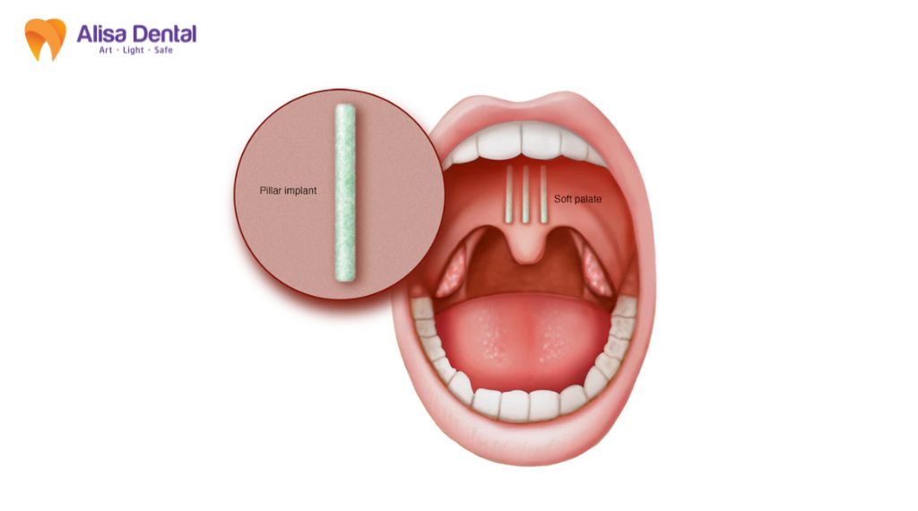 dental implant cost Hanoi