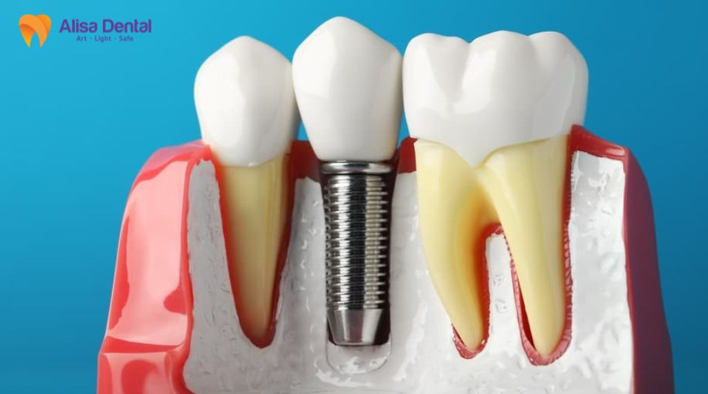dental implant cost Hanoi