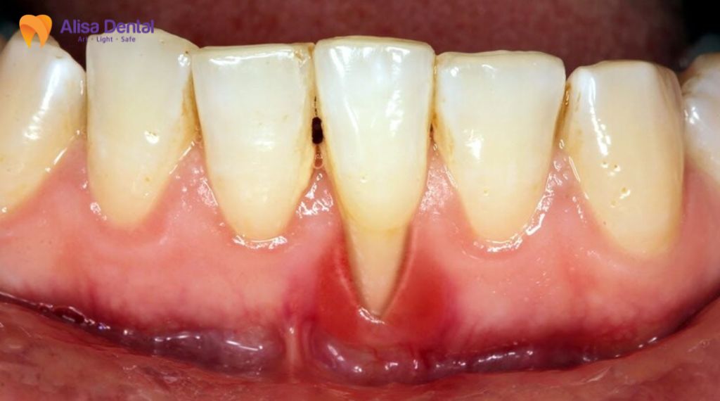 Ê buốt răng do uống đồ lạnh