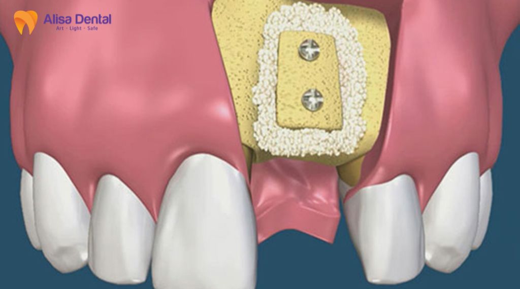Ghép xương trong trồng răng implant là gì